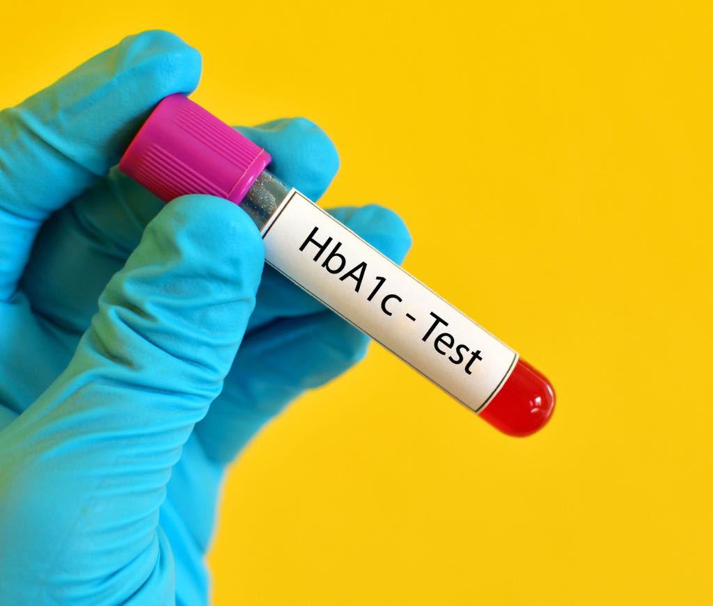 HbA1 C test